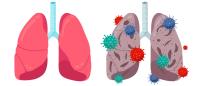 Illustration of two pairs of lungs, one surrounded by multicolored spiky viruses